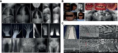 A New SLC10A7 Homozygous Missense Mutation Responsible for a Milder Phenotype of Skeletal Dysplasia With Amelogenesis Imperfecta